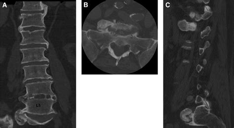 L5 Radiculopathy Caused By L5 Nerve Root Entrapment By An L5 Erofound