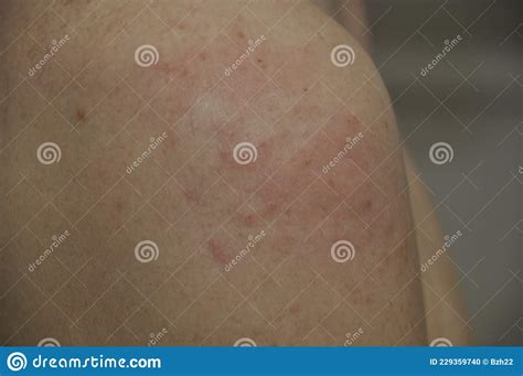 Eczema Pimples On A Shoulder Stock Photo Image Of Problems Skin