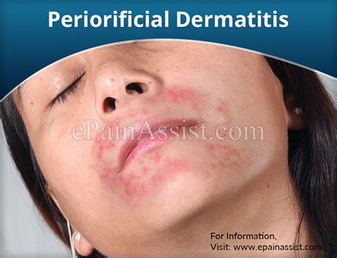 Periorificial Dermatitiscausessymptomstreatmenthow Long Does It