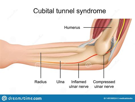 Cubital Tunnel Syndrome Inflamed Ulnar Nerve Medical Vector