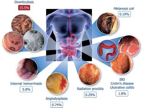 Management Of Colonic Diverticular Disease In The Third Millennium