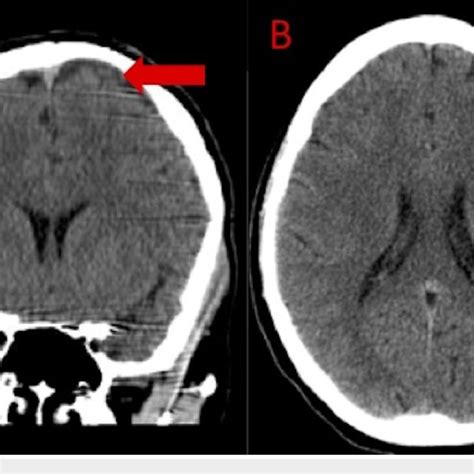 Noncontrast Head Computed Tomography Two Months After Craniotomy A