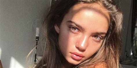 Model Inka Williams Shares Her Battle With Acne Which She Claims Was