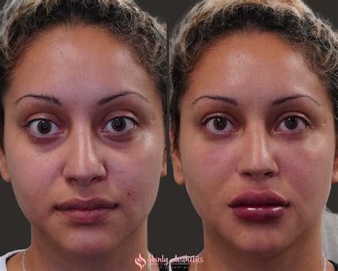 Lip Filler Before After Results Skinly Aesthetics