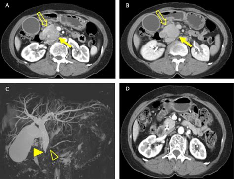 A number of types of pancreatic cancer are known. Pancreatic Cancer Ct Scan With Contrast - ct scan machine