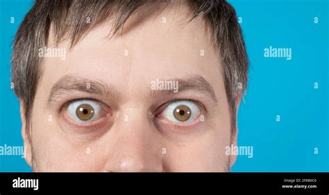 Bulging Eyes Hi Res Stock Photography And Images Alamy