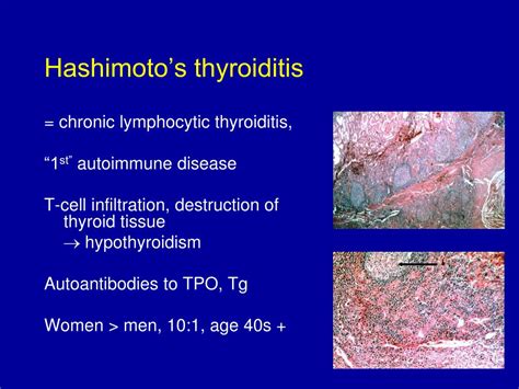 Ppt Thyroid Disease Powerpoint Presentation Free Download Id1147073