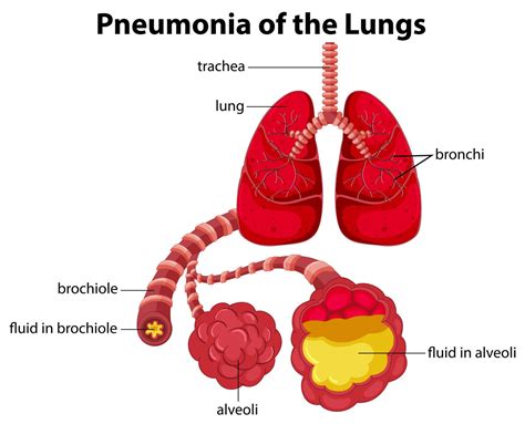 Pneumonia Harvard Health