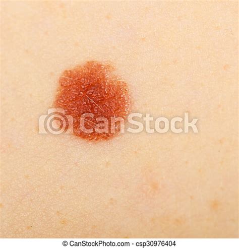Closeup Brown Mole On Caucasian Woman Skin Skin Disease Closeup Brown