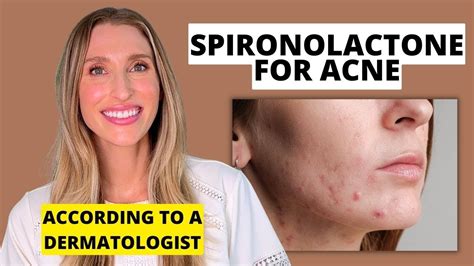 Dermatologist Explains Spironolactone For Acne Treatment Dr Sam