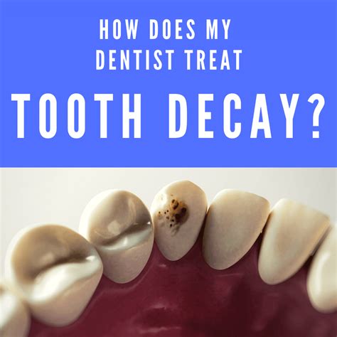 How Does My Dentist Treat Tooth Decay Mccartney Dental