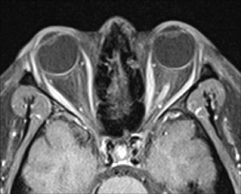 A Postcontrast Axial T1 Weighted Fat Suppressed Mri Of The Orbits In A