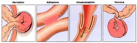 This is caused by twisting of the intestines. Bowel Obstruction | Bowel obstruction, Small bowel ...