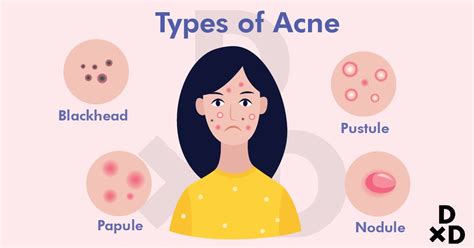 The Ultimate Guide To Acne Treatments In Singapore 2020 Doctorxdentist