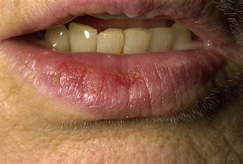 Sunburned Lips Symptoms Causes Treatment Home Remedies Prevention