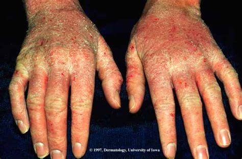 Atopic Dermatitis Hands Pictures Photos