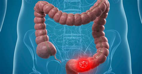 Colon Cancer Causes And Risk Factors