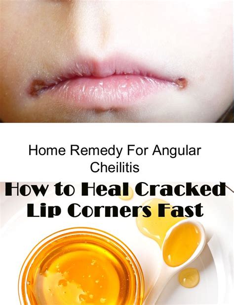 Cracked Lips In Corner Of Mouth Home Remedies Home Rulend