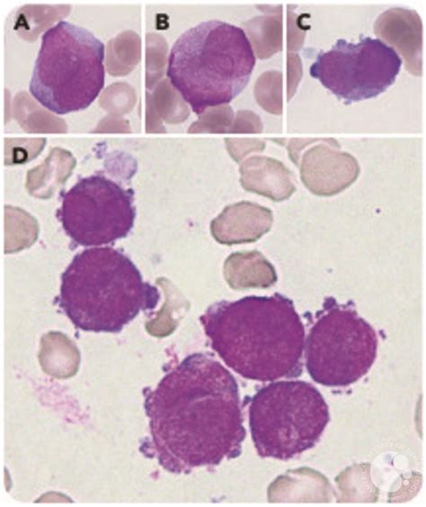 Acute Promyelocytic Leukemia Microgranular Variant