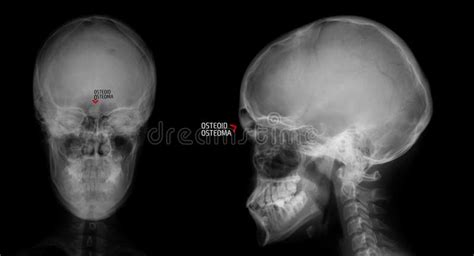 X Ray Of The Skull Osteoid Osteoma Of The Frontal Sinus Marker Stock