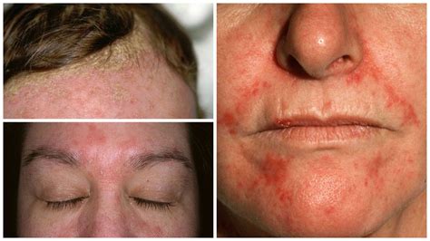 5 Tratamientos Efectivos Y Naturales Contra La Dermatitis Seborreica