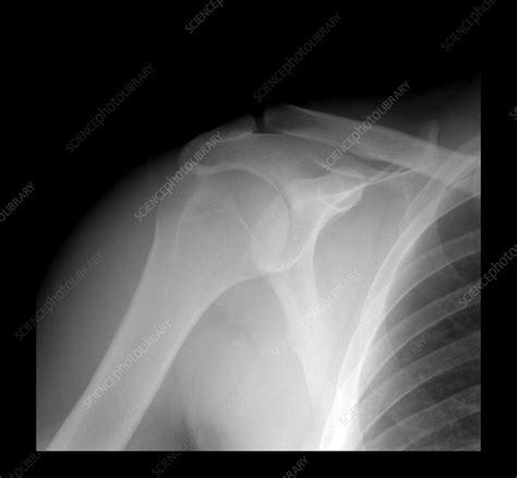 Normal Shoulder X Ray Stock Image C0034584 Science Photo Library