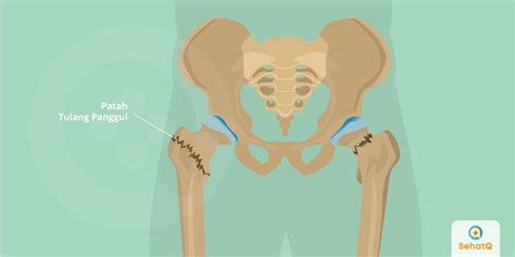 Detail Gambar Tulang Pelvis Dan Penjelasan Koleksi Nomer