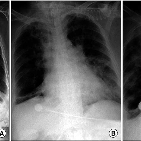 Chest Radiographic Findings A On 1 St Day Chest Radiograph Shows