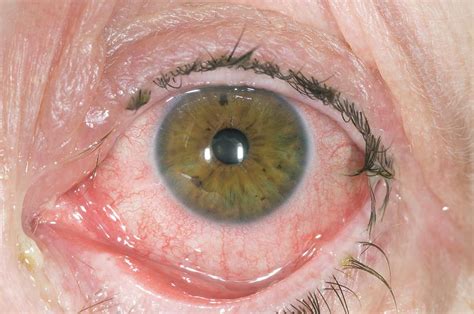 Red Eye From Bacterial Conjunctivitis Photograph By Dr P Marazzi