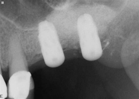 Case Study Sinus Lift Procedure Pinole Ca Dental Implants Placement