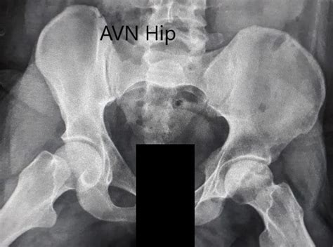 Case Study Left Hip Total Replacement In 55 Year Old Male