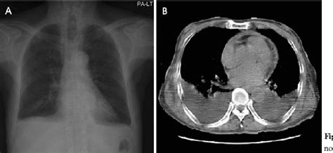 Figure 1 From Bilateral Pleural Effusion Possibly Related To Amantadine