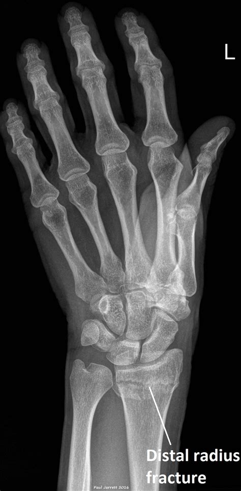 Distal Radial Fractures Murdoch Orthopaedic Clinic
