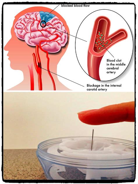 Find Out How To Save A Person With A Stroke Using Only One Needle