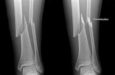 Trauma X Ray Lower Limb Gallery 1 Tibiafibula Fractures