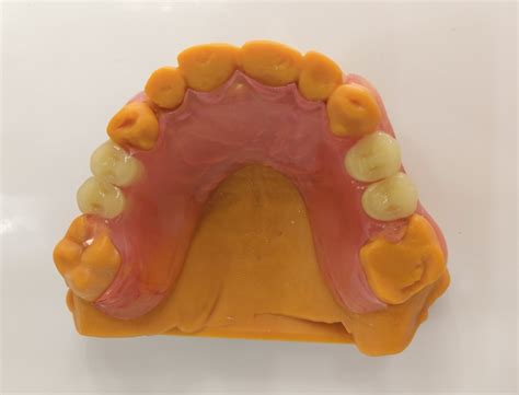 China Custom Partial Valplast Flexible Denture with Acrylic Tooth From ...