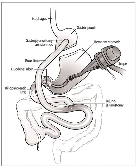 Intraoperative Endoscopy In Patient Who Underwent Rouxen Y Gastric Download Scientific Diagram