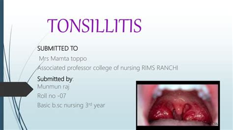 Everything You Need To Know About Tonsillitis Ppt