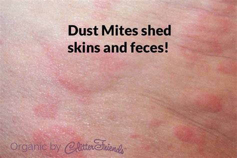 Dust Mite Bites Vs Bed Bug Bites Home Decor