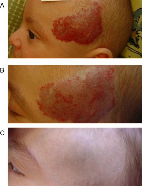 Laser Treatment In The Management Of Infantile Hemangiomas And
