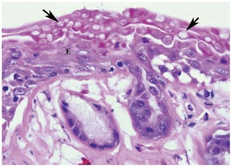 Histological View Of Skin From Lethally Infected Individual