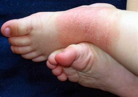 Dermatite Atopica Cause Sintomi E Rimedi In Adulti E Bambini