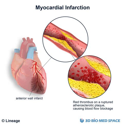 Myocardial Infarction Cardiovascular Medbullets Step