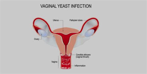 Vulvar Ulcers All You Need To Know About This Condition From An Expert