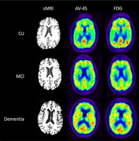 Rapid Amyloid Pet Scans Show Promise In Alzheimers Disease