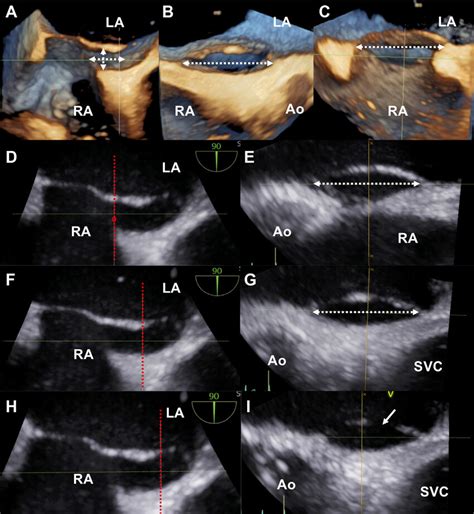 Case 1 Volumetric And Multiplanar 3d Tee Images Of Pfo A