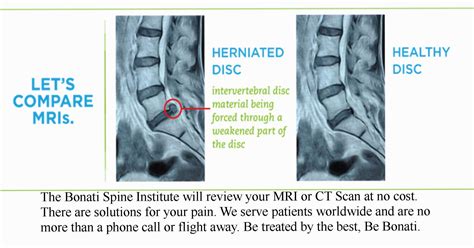 Herniated Disc Seen Here This Is One Of Many Reasons To Be Open To The Bonati Procedure Open