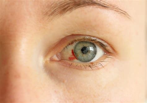 Sintomas De Un Derrame En El Ojo Consejos Ojos