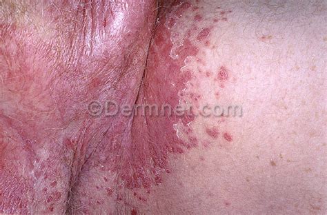 Some could be caused due to problems within the body while some could be contracted externally such as groin rashes caused by stds (sexually transmitted diseases). Female Rash Groin Area