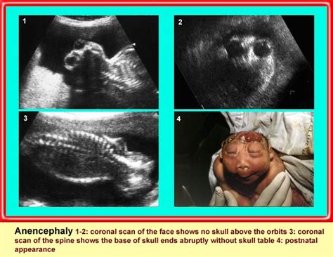 Anencephaly Department Of Obstetrics And Gynecology Faculty Of